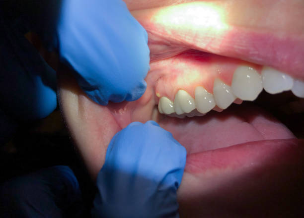 Best Emergency Denture Repair in Milton, FL